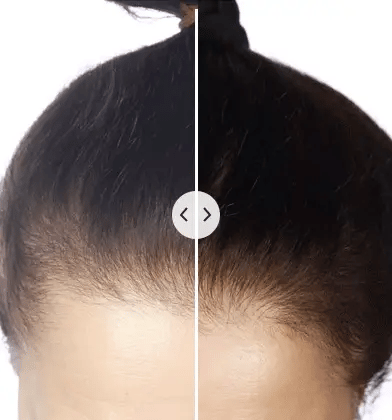 HeadRelax™ | Elektrischer Haarverjünger