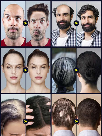 Haaröl Kopfhaut | Nährt Kopfhaut und Haarwurzeln | Unterstützt dichteres Haargefühl | Follicare