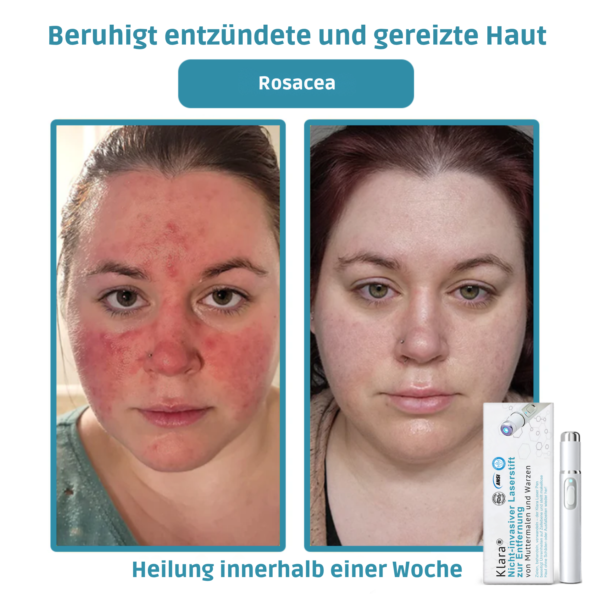 Klara™ Schmerzfreier Laser-Stift — Enthülle jederzeit makellose Haut und Selbstvertrauen
