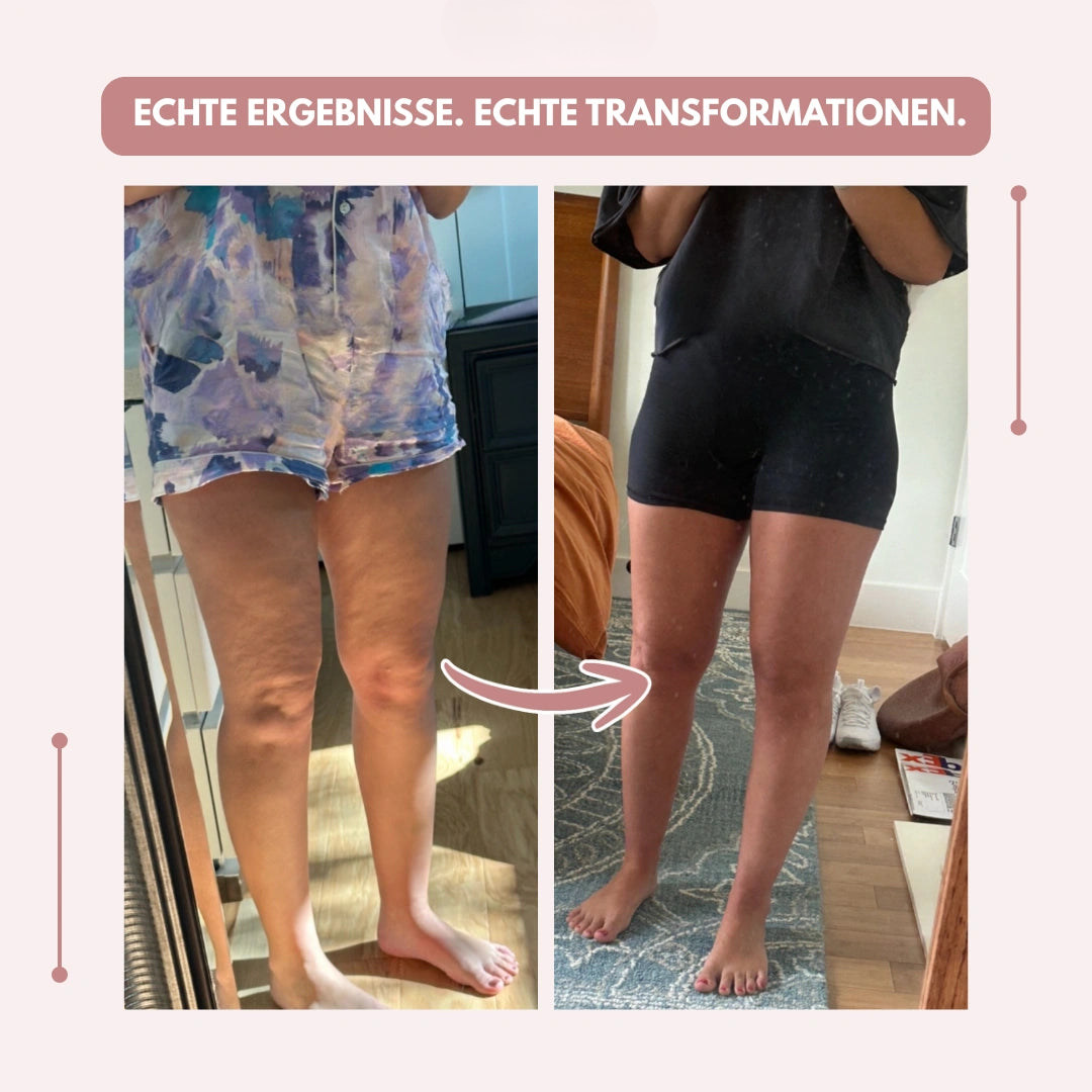 Kompressionsleggings mit hoher Taille | Lipödem schmerzen | FlexContour