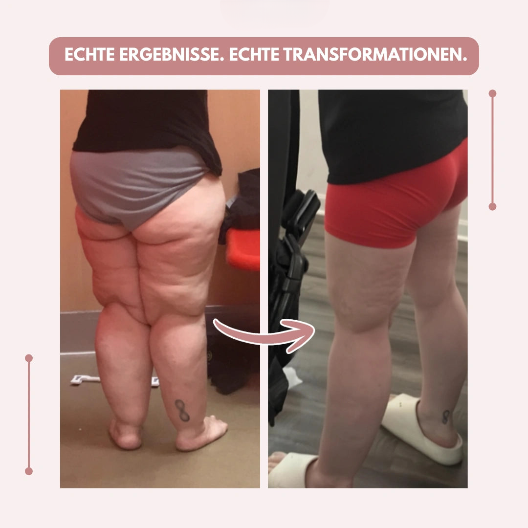 Kompressionsleggings mit hoher Taille | Lipödem schmerzen | FlexContour
