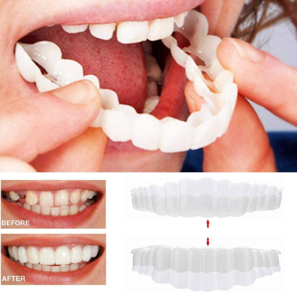 Veneers | Ultradünnes Acrylharz | Sofortiges Lächeln | Smilence