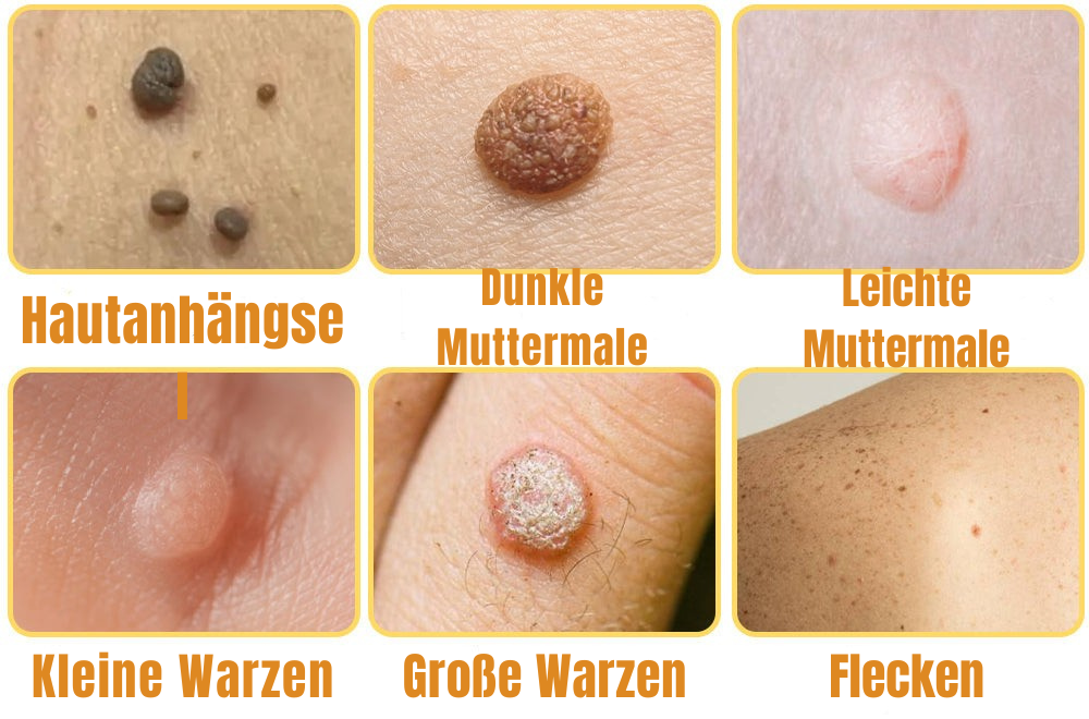 Warzenentferner | Warzen Spray | Bienengift Formel | Schmerzfrei | SkinPurex