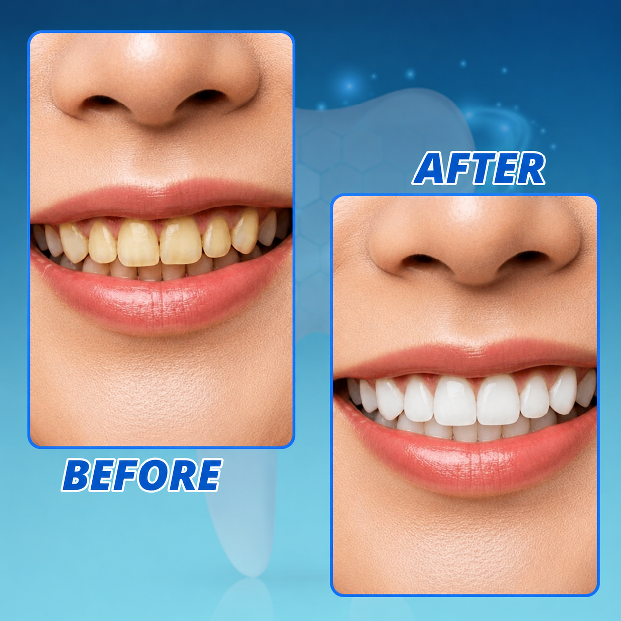 Zahnaufhellung Whitening-Stift 5 | Schonende Peroxid-Formel | Alle Zahntypen | PearlDrop
