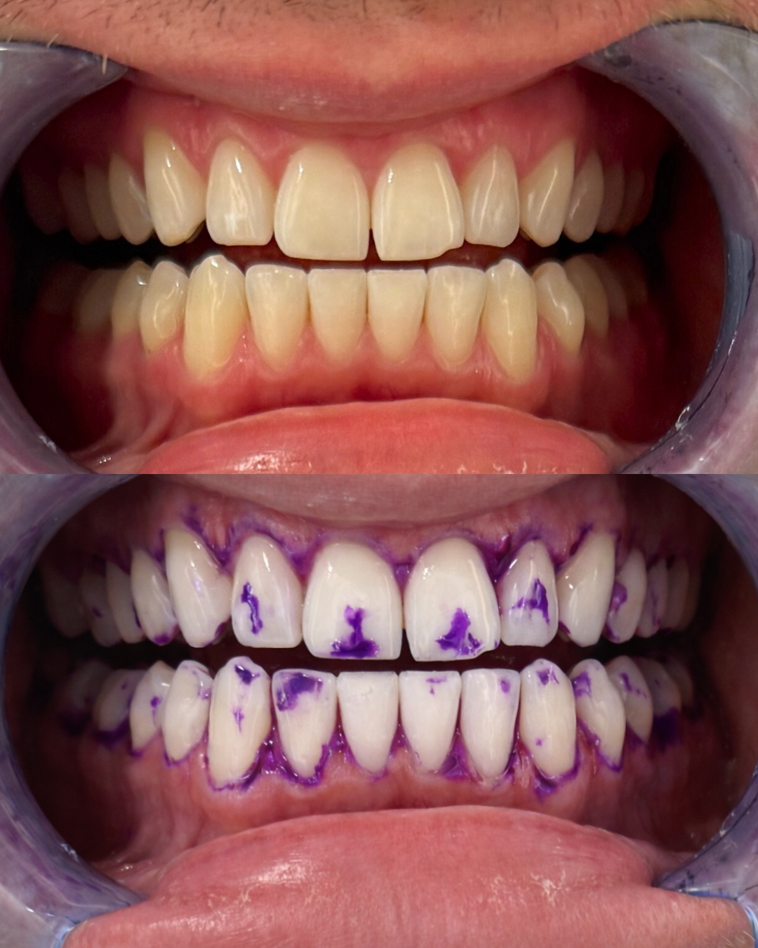 Zahnaufhellungsstreifen | 30 Minuten Anwendung | Flexible Streifen | BrightStrip