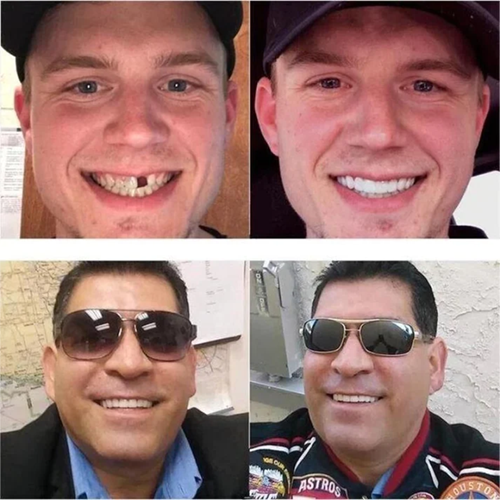 Zahnprothese zum Aufstecken | Einstellbare Passform | Natürliches Lächeln | SnapSmile